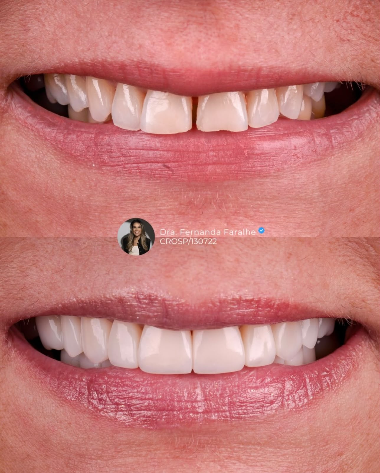 Antes e depois — Sorriso