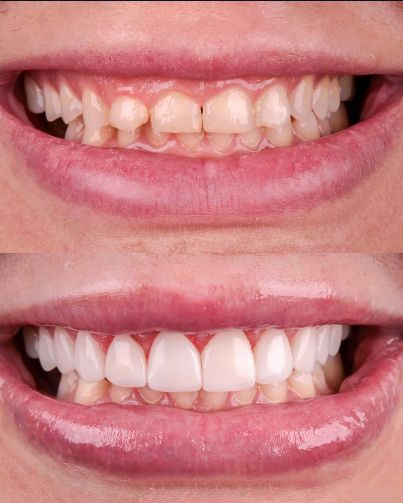 Antes e depois — Sorriso