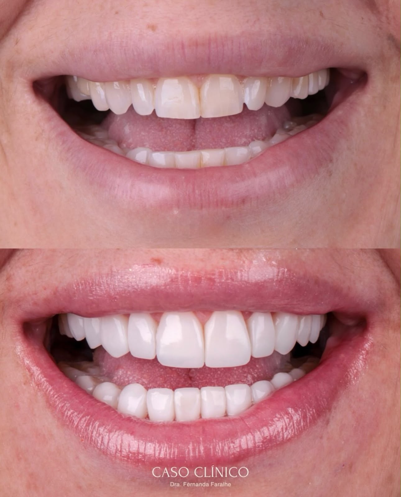 Antes e depois — Sorriso