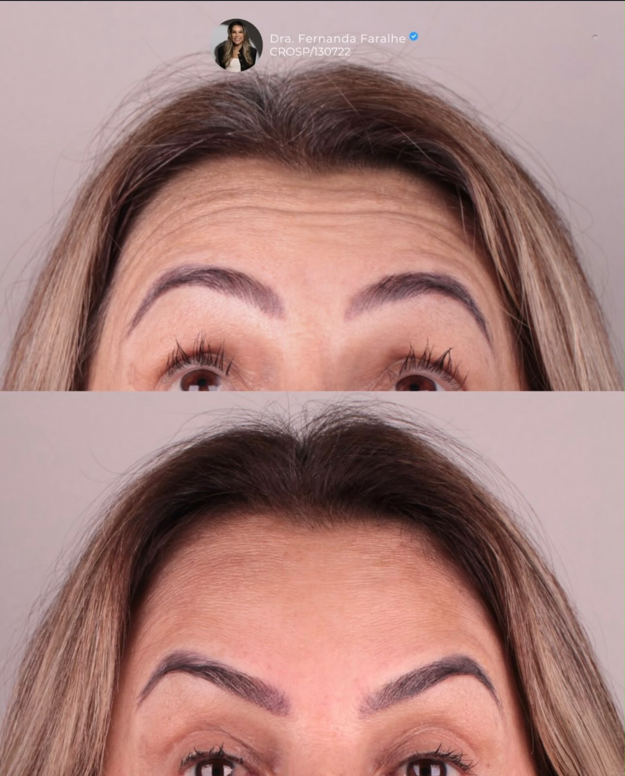 Antes e depois — Testa