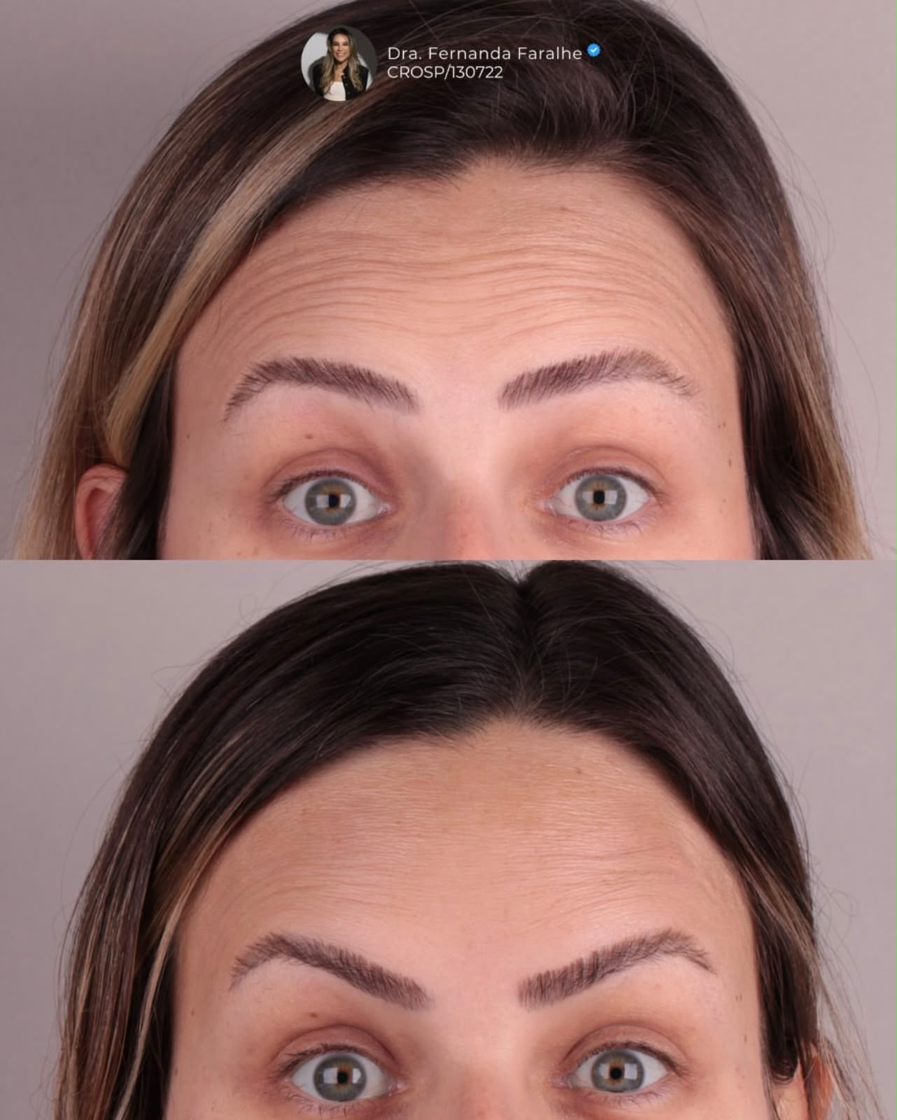 Antes e depois — Testa